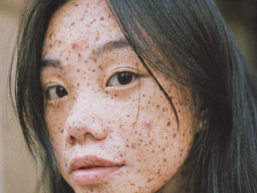 Acne: Tough on Your Skin and Your Self-esteem