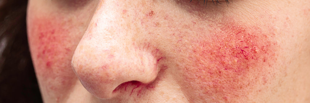 Rosacea: Understanding and Managing the Different Types